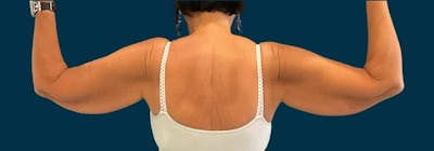 Brachioplasty (Arm Lifts) Before & After Gallery - Patient 609270 - Image 1