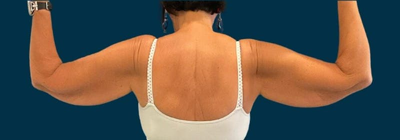 Brachioplasty (Arm Lifts) Before & After Gallery - Patient 609270 - Image 1