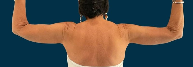 Brachioplasty (Arm Lifts) Before & After Gallery - Patient 609270 - Image 2