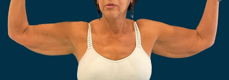 Brachioplasty (Arm Lifts) Before & After Gallery - Patient 609270 - Image 3
