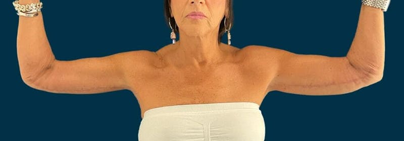 Brachioplasty (Arm Lifts) Before & After Gallery - Patient 609270 - Image 4