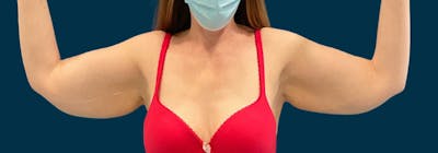 Brachioplasty (Arm Lifts) Before & After Gallery - Patient 352273 - Image 1