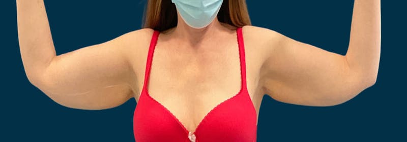 Brachioplasty (Arm Lifts) Before & After Gallery - Patient 352273 - Image 1