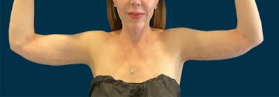 Brachioplasty (Arm Lifts) Before & After Gallery - Patient 352273 - Image 2