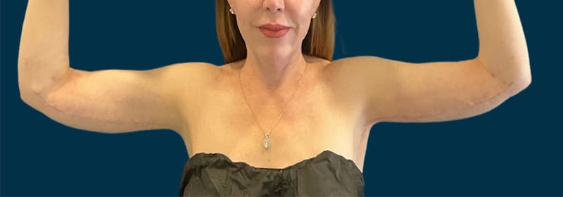 Brachioplasty (Arm Lifts) Before & After Gallery - Patient 352273 - Image 2