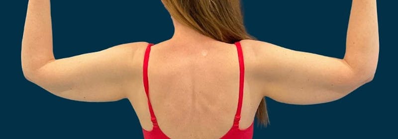 Brachioplasty (Arm Lifts) Before & After Gallery - Patient 352273 - Image 3