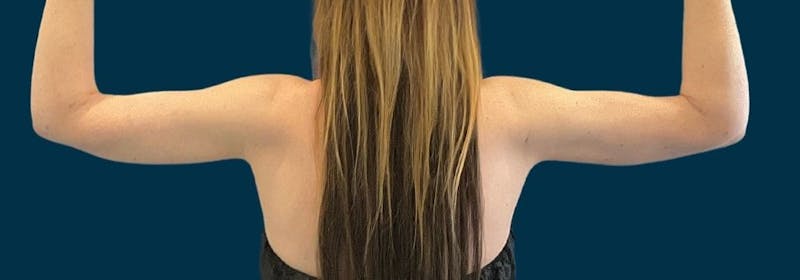 Brachioplasty (Arm Lifts) Before & After Gallery - Patient 352273 - Image 4