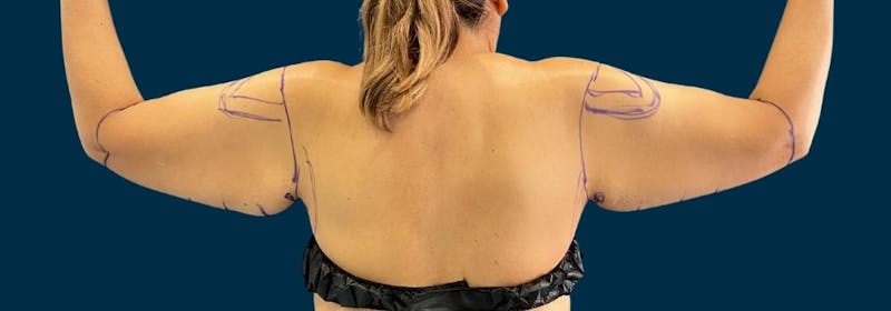 Brachioplasty (Arm Lifts) Before & After Gallery - Patient 788976 - Image 1
