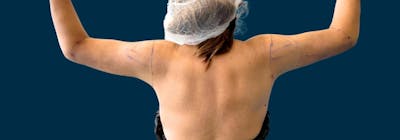 Brachioplasty (Arm Lifts) Before & After Gallery - Patient 788976 - Image 2
