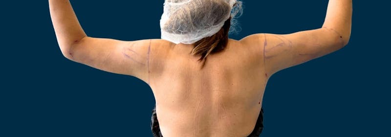 Brachioplasty (Arm Lifts) Before & After Gallery - Patient 788976 - Image 2