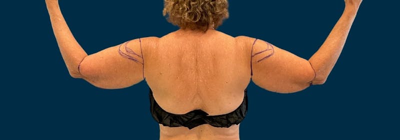 Brachioplasty (Arm Lifts) Before & After Gallery - Patient 171474 - Image 1