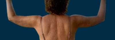 Brachioplasty (Arm Lifts) Before & After Gallery - Patient 171474 - Image 2
