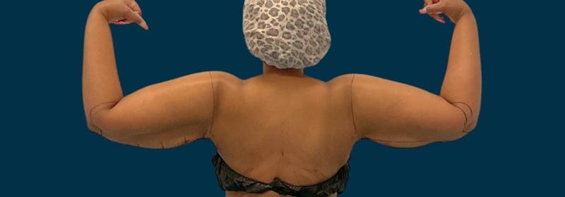Brachioplasty (Arm Lifts) Before & After Gallery - Patient 156898 - Image 1