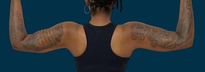 Brachioplasty (Arm Lifts) Before & After Gallery - Patient 156898 - Image 2