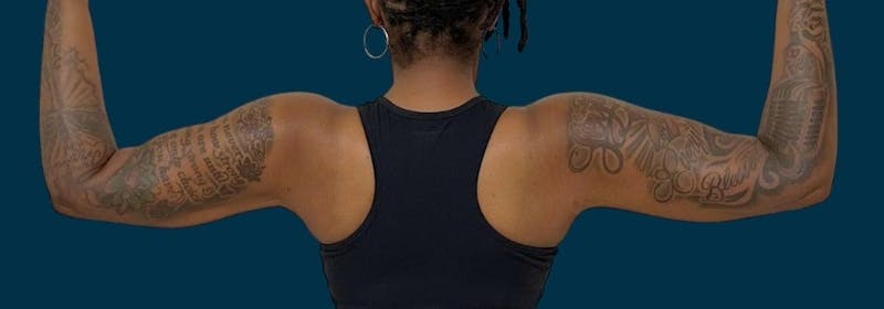 Brachioplasty (Arm Lifts) Before & After Gallery - Patient 156898 - Image 2