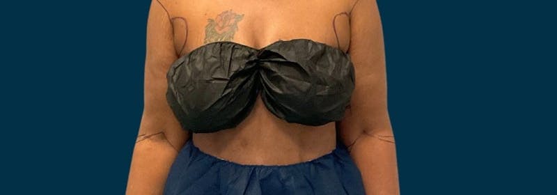 Brachioplasty (Arm Lifts) Before & After Gallery - Patient 156898 - Image 3