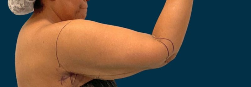 Brachioplasty (Arm Lifts) Before & After Gallery - Patient 156898 - Image 5