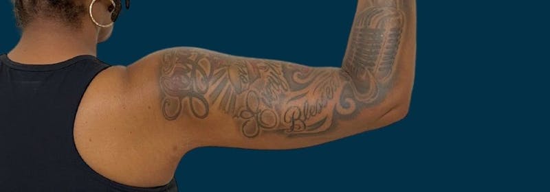 Brachioplasty (Arm Lifts) Before & After Gallery - Patient 156898 - Image 6