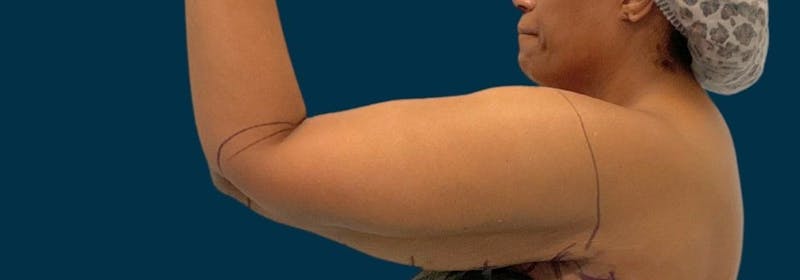 Brachioplasty (Arm Lifts) Before & After Gallery - Patient 156898 - Image 7