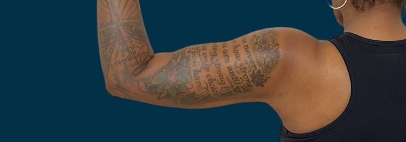 Brachioplasty (Arm Lifts) Before & After Gallery - Patient 156898 - Image 8