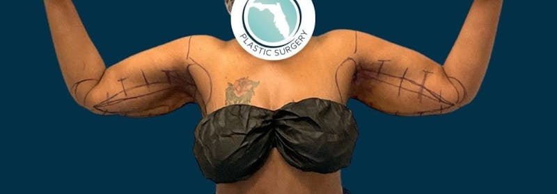 Brachioplasty (Arm Lifts) Before & After Gallery - Patient 156898 - Image 9