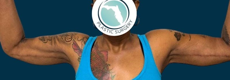 Brachioplasty (Arm Lifts) Before & After Gallery - Patient 156898 - Image 10