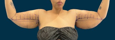 Brachioplasty (Arm Lifts) Before & After Gallery - Patient 350620 - Image 1