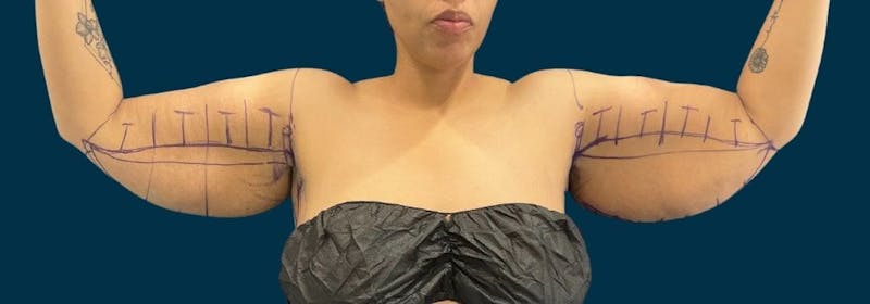 Brachioplasty (Arm Lifts) Before & After Gallery - Patient 350620 - Image 1