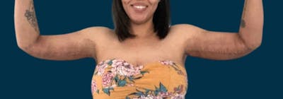 Brachioplasty (Arm Lifts) Before & After Gallery - Patient 350620 - Image 2
