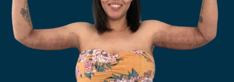 Brachioplasty (Arm Lifts) Before & After Gallery - Patient 350620 - Image 2