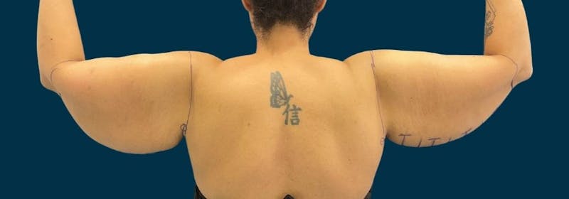 Brachioplasty (Arm Lifts) Before & After Gallery - Patient 350620 - Image 3