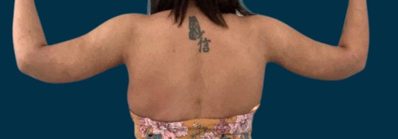 Brachioplasty (Arm Lifts) Before & After Gallery - Patient 350620 - Image 4