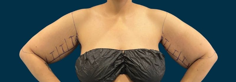 Brachioplasty (Arm Lifts) Before & After Gallery - Patient 350620 - Image 5