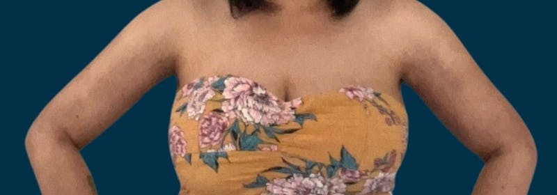 Brachioplasty (Arm Lifts) Before & After Gallery - Patient 350620 - Image 6
