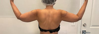 Brachioplasty (Arm Lifts) Before & After Gallery - Patient 193209 - Image 1