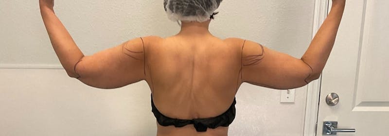 Brachioplasty (Arm Lifts) Before & After Gallery - Patient 193209 - Image 1