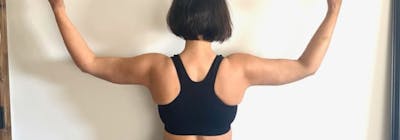 Brachioplasty (Arm Lifts) Before & After Gallery - Patient 193209 - Image 2
