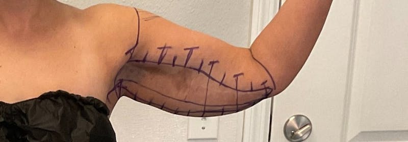 Brachioplasty (Arm Lifts) Before & After Gallery - Patient 193209 - Image 3