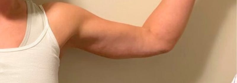 Brachioplasty (Arm Lifts) Before & After Gallery - Patient 193209 - Image 4