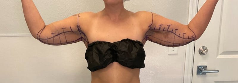 Brachioplasty (Arm Lifts) Before & After Gallery - Patient 193209 - Image 5