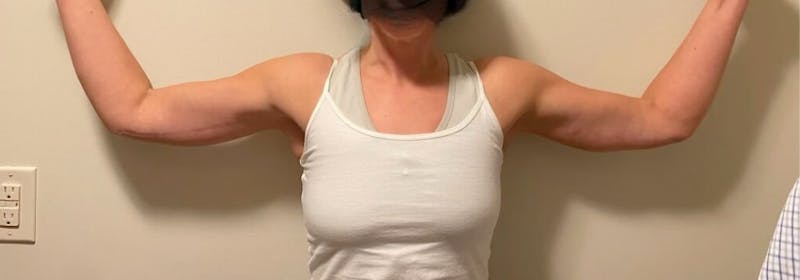 Brachioplasty (Arm Lifts) Before & After Gallery - Patient 193209 - Image 6