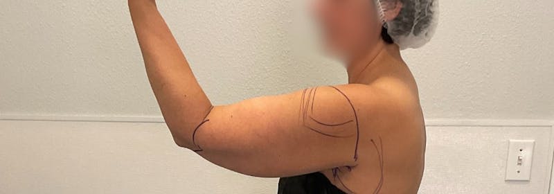 Brachioplasty (Arm Lifts) Before & After Gallery - Patient 193209 - Image 7