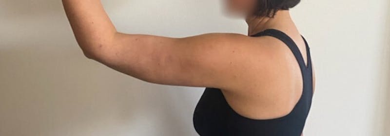 Brachioplasty (Arm Lifts) Before & After Gallery - Patient 193209 - Image 8