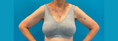 Brachioplasty (Arm Lifts) Before & After Gallery - Patient 335379 - Image 1