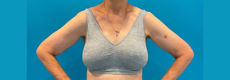 Brachioplasty (Arm Lifts) Before & After Gallery - Patient 335379 - Image 1