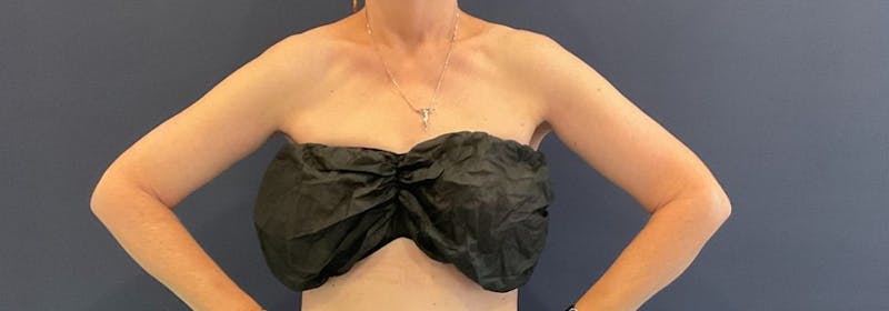 Brachioplasty (Arm Lifts) Before & After Gallery - Patient 335379 - Image 2