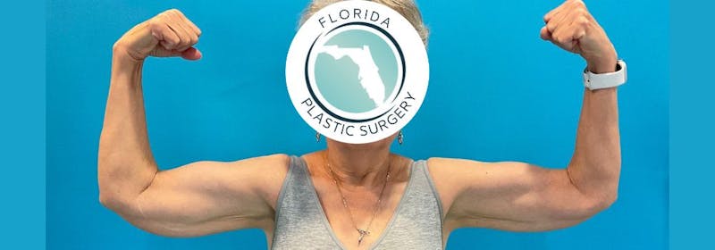 Brachioplasty (Arm Lifts) Before & After Gallery - Patient 335379 - Image 3