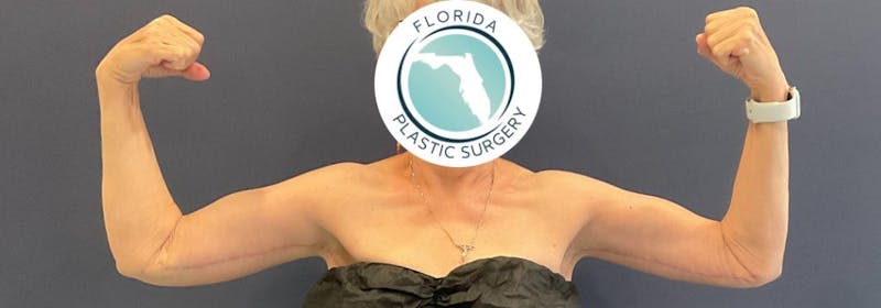 Brachioplasty (Arm Lifts) Before & After Gallery - Patient 335379 - Image 4