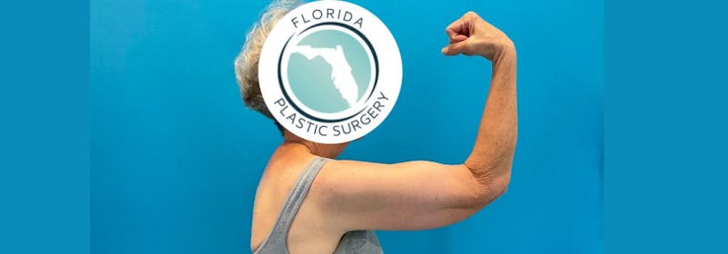 Brachioplasty (Arm Lifts) Before & After Gallery - Patient 335379 - Image 5