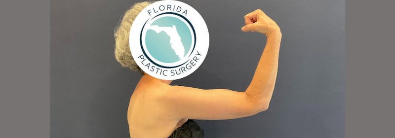 Brachioplasty (Arm Lifts) Before & After Gallery - Patient 335379 - Image 6